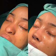 Nose Job For Wide Nose, Wide Nose Surgery, Dream Nose Job, Nose Job Droopy Tip, Nose Job Wide Nose, Nose Jobs Black Women, Droopy Tip Nose Rhinoplasty, Nose Job From Front View, Nose Job Thick Skin