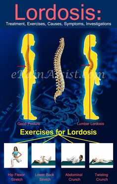 Lordosis Exercises, Lumbar Exercises, Lumbar Lordosis, Nervus Vagus, Yoga And Stretching, Pelvic Tilt