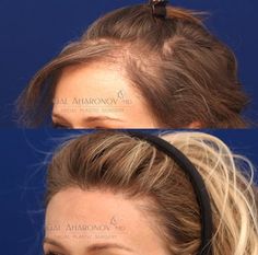 | HAIRLINE LOWERING SURGERY