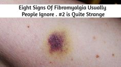 Eight Signs Of Fibromyalgia Usually People Ignore . #2 is Quite Strange – Med Line Plus Causes Of Fatigue, Fatigue Symptoms, Chronic Fatigue Symptoms, Chronic Fatigue, Autoimmune Disease, Chronic Pain, Signs