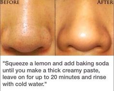 Jus Lemon, Blackhead Remedies, Black Heads, Get Rid Of Blackheads, Beauty Remedies, Acne Remedies, Skin Pores