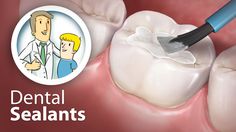 Prevent Cavities. Ask your dentist about dental sealants and fluoride applications to protect your child's teeth. Teeth Decay, Coconut Oil Teeth Whitening, Wisdom Teeth Funny