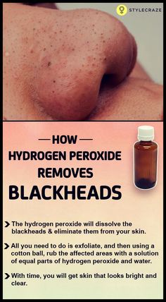 Are you tired of those blackheads on your face? Removing them can be a challenge. But don’t worry, as there is one simple and effective way of getting rid of those blackheads. It is by using hydrogen peroxide. Wondering how that can help you remove your blackheads? Then read this post! #Blackheads Black Heads, Get Rid Of Blackheads, Hydrogen Peroxide, Blackhead Remover, The Skin