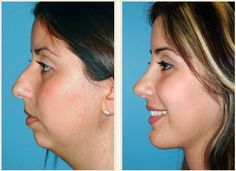 Jaw Reduction Surgery, Nose Plastic Surgery, Nose Surgery Rhinoplasty, Plastic Surgery Fail, Chin Augmentation, Rhinoplasty Nose Jobs, Plastic Surgery Gone Wrong, Face Surgery, Rhinoplasty Surgery