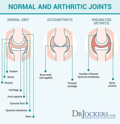 Joint Pain: Top 12 Natural Strategies for Pain Relief - DrJockers.com Synovial Fluid, Back Pain Remedies, Body Joints, Muscle Pain Relief, Uric Acid, Joints Pain Relief, Natural Pain Relief, Nerve Pain, Back Pain Relief