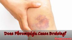 Fibromyalgia and Bruising: Effects of an invisible disease Chronic Back Pain, Chronic Fatigue Symptoms, Auto Immune, Itchy Skin