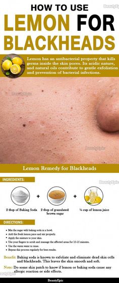 For Blackheads, Skin Care Routine For 20s, Cold Home Remedies, Natural Cough Remedies, Cold Remedies