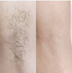 Wax Before After, Laser Hair Removal Men, Beauty Bar Salon, Instagram Eyebrows, Underarm Waxing, Ramadan Kareem Pictures, Waxing Salon, Painless Hair Removal