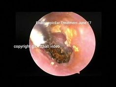 Become a member of my channelhttps://www.youtube.com/channel/UCDcagqzORMEgoqkSIntVpOQ/joinear wax removal,Regular cerumen clearance, 13 min Impacted Earwax Removal Video, Earwax Removal Video Satisfying, Clean Ear Wax Out, Best Ear Wax Removal, Candle Ear Wax Removal, Impacted Ear Wax, Ear Wax Removal Video, Ear Pimple, Ear Cleaning Wax