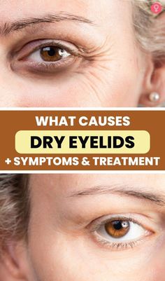 Dry Eyelids, Natural Skin Lightening, Beauty Hacks Skincare, Genetic Disorders, Environmental Factors, Skin Discoloration, Skin Skincare, Unhealthy Food, Skincare Tips