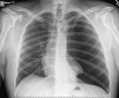 an x - ray image shows the chest and lung area, with no visible ribs