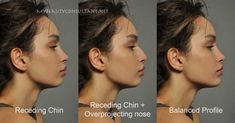 #plasticsurgery #plasticsurgerygonewrong #beforeafter #celebritiesbeforeafter #hollywoodstars #bignosesurgery #surgery #facesurgery #vlinesurgery #koreanplasticsurgery #kpopplasticsurgery #nosejob #jawreductionsurgery #eyesurgery #cheekfillers #rhinoplasty #facelift #plasticsurgeryfails #expensiveplasticsurgery Chin Filler, Chin Implant