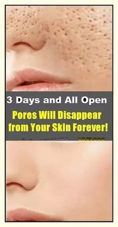 How To Make Pores Disappear With Only Natural Ingredients Artery Cleanse, Big Pores, Lotion For Oily Skin, Face Pores, Tips For Oily Skin, Face Tips, Open Pores, Skin Care Wrinkles, Moisturizer For Oily Skin