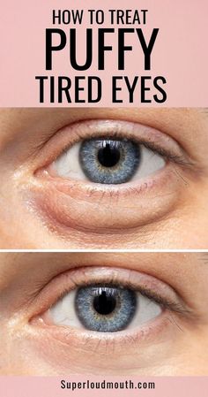 What your Eye bags tell about your health? How to get rid of them? Eye Bag Remedies, Baggy Eyes, Under Eye Bags, Beauty Remedies, Tired Eyes, Looks Black