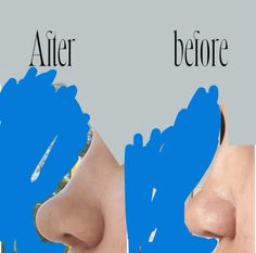 before and after photos of a woman's nose