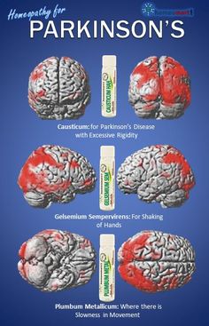 Tissue Salts, Parkinsons Awareness, Loss Of Balance, Doctor Dress, Slow Movement, Physical Therapy Exercises