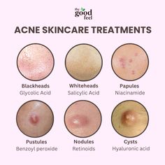 Make better choices and achieve clearer, more radiant skin!🧴🌸  [ the good feel, skin health, acne problems, face serum, Whiteheads, breakouts, blackheads, acne treatment, acne problems, serums for acne]  #thegoodfeel #skincaretips #skintreatment #skinproducts #acneproneskincare #acnetreatmentset #healthandwellbeing #blackheadsremoval #whiteheads #breakoutskin #skinhealthtips #darkspotserum #acnetreatments #acnetreatments #skinbreakout Active Acne Remedies, Dry And Acne Prone Skin, Face Problems Skin, Acne Breakout Chart, Acne Around Mouth And Chin, Reasons For Acne On Face, Skin Care For Sensitive Acne Prone Skin, Acne Placement, Skin Problems Face