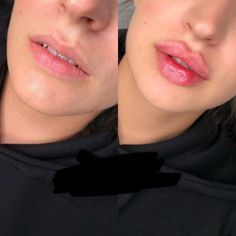 Lip Fillers Juvederm, Dermal Fillers Lips, Lips Fillers, Lips Shape, Face Fillers