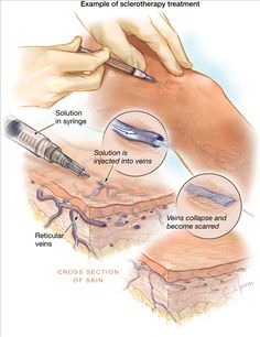 Sclerotherapy. What happens during a procedure for leg veins. Vein Health, Varicose Vein Remedy, Hormonal Imbalances, Leg Veins, Cosmetic Dermatology, Winston Salem Nc, Aesthetic Medicine, Image Description, Dermal Fillers