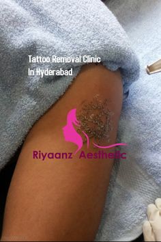 tattoo removal clinic in hyperabd - riyaanz aesthetics, inc