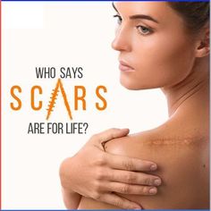 A scar is an injury that occurs on the skin. It is a mark that remains in the dermis after skin regeneration of damaged tissue (injury, surgery, disease, acne ...). Patients with visible scars (area of ​​the face, hands, legs) suffer from depression, anxiety and insecurities. Today it is possible to erase them from the skin, and in the most complex cases, it is possible to soften them with innovative minimally #laserscartreatmentindelhi #scartreatmentindelhi #scartreatment Hypertrophic Scars, C Section Scars, Fractional Laser, Scar Cream, Beauty Advertising, Skin Regeneration, South Delhi, Hair Specialist, Scar Removal