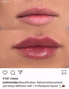 Good Lip Filler Pictures, Lip Blush And Filler, Sydney Sweeney Lips, Lip Filler 2ml, Perfect Lips Injections, .5 Lip Filler, Lip Filler On Small Lips