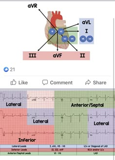 12 Lead Ekg Interpretation Cheat Sheets, Cardiac Cath Lab Nurse, Cath Lab Nursing, Medical Assistant Student, Nursing Information