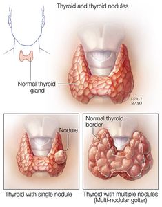 What Is Hashimotos Disease, Low Thyroid Remedies, Enlarged Thyroid, Low Thyroid, Thyroid Issues