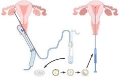 How to Increase Your Chances of Embryo Transfer Success? - the Lucky Egg Embryo Adoption Announcement, Egg Retrieval Ivf, Ivf Tips, Ivf Journey, Fertility Doctor