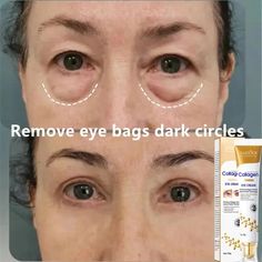 Instant Eye Bag Removal Cream Collagen Anti-Wrinkle Firming Skin Fade Face Depuffing, Eye Bag Removal, Limoncello Recipe, Remove Eye Bags, Botox Face, Eye Wrinkle Cream, Clean Blackheads, Tone Face, Firming Skin