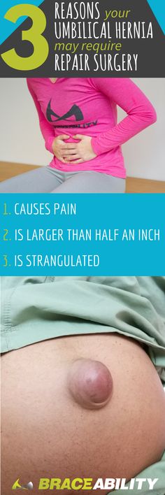 Do you need umbilical hernia repair surgery? Umbilical hernia repair surgery is a procedure that fixes navel hernias. An umbilical hernia involves a bulge, bump, or protrusion that forms in your stomach. This type of bulge occurs when a part of your intestine or other abdominal cavity tissue pushes through a weak spot in the abdominal wall near your belly button. Your hernia may require surgery if it is causing a lot of pain, is larger than half an inch or is strangulated. Abdominal Cavity, Ab Day, Funny Drawings, Binders, Job Search