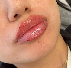 Lip Injections Natural, Lip Filler Inspiration 1ml, Russian Lip Filler Technique, Lip Fillers Before And After 1ml, Type Of Lips, Russian Lips Filler, Lips Injection, Lip Pmu