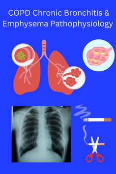 COPD (Chronic Obstructive Pulmonary Disease) is COPD is a term that refers to both Chronic Bronchitis & Emphysema. In this video we will discuss the differences between the two, symptoms and the main cause for both. Living with a chronic lung disease can be difficult and you may feel isolated. We will discuss finding support groups that can help you share your feelings with other people living with COPD. Chronic Lung Disease, Chronic Obstructive Pulmonary Disease, Support Groups, Pulmonary Disease, Lung Disease, People Living, Support Group, Other People