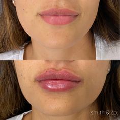 Kysse Lips Filler Before And After, Lip Lift, Danielle Smith, Cosmetic Dermatology