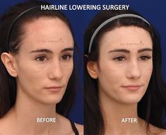 | HAIRLINE LOWERING SURGERY Body Enhancement, Ethnic Rhinoplasty, Plastic Surgery Korea, Small Forehead, Rhinoplasty Nose Jobs, Beauty Tech