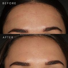 Frown Lines Between Eyes, Forehead Filler, Injectables Aesthetic, Botox Units, Wrinkles On Forehead, Botox Lip Flip, Montana Brown