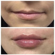 Eye Lift Surgery, Fake Lips, Lip Augmentation