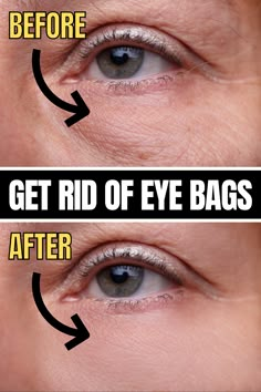 Today, we're sharing 19 best ways to get rid of bags under eyes fast. #eyebags #darkcircles Undereye Bags Remedy, Get Rid Of Eye Bags, Rid Of Eye Bags, Eye Bag Remedies, Puffy Bags, Puffy Eyes Remedy, Wrinkles Remedies Face, Saggy Neck, Bags Under Eyes