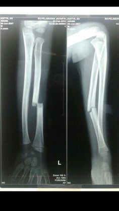 an x - ray shows the foot and ankle bones in this image, both with different angles