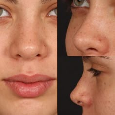 Nose Problems, Nose Reshaping, Face Surgery, Rhinoplasty Surgery, Pretty Nose, Perfect Nose