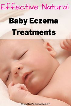 Natural Remedies for Baby's Eczema.  Learn how to treat eczema from home.  Learn what baby eczema is and how to naturally treat it. Biracial Babies, Mommy Hacks, Snoring Remedies, Pinterest Friends, Mommy Tips, Sponsored Posts, Poor Children, Mom Stuff