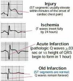 Ekg Notes, Cardiology Nursing, Nursing Mnemonics, Cardiac Nursing, Pa School, Critical Care Nursing