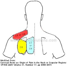 Pain in the neck or scapular region is one of the most frequent symptoms of a pinched nerve. This neck pain usually is the first sign of radiculopathy and can appear before any symptoms of pain, numbness, or weakness in the arm or fingers. Because typical signs of a pinched nerve in the arm or fingers can be delayed by weeks, this often leads to assumptions that other structures such as muscles are the cause of the neck pain. Pinched Nerve In Neck, Stiff Neck Remedies, Mid Back Pain, Spinal Nerve, Pinched Nerve, Back Pain Remedies, Spine Health, Neck Pain Relief