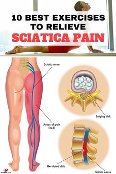 Sciatica pain starts in the upper portion of our leg and moves up to our lower spineIt manifests itself as numbnesspainor a burning sensationThe sciatica nerve might get caught in the spine canalor it can be the result of an injury or a slipped diskBut is there any solutions for sciatica painThe good news is that with conservative treatmentwe can minimize the symptoms greatly within a few weeksHere are the 10 best exercises to relieve sciatica pain. Inner Knee Pain, Sciatica Symptoms, Sciatica Exercises, Sciatica Pain Relief, Upper Back Pain, Nerve Pain Relief, Sciatic Nerve Pain, Knee Pain Relief, Sciatica Pain