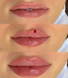 Lip Filler Inspiration Heart Shaped, Lip Injections Heart Shape, Keyhole Pout Lip Filler, Lip Injections Inspiration, Jolie Lip Filler, Lip Injection Inspiration, 1.5 Ml Lip Filler, Lip Filler Lips, 1ml Lip Filler Shapes