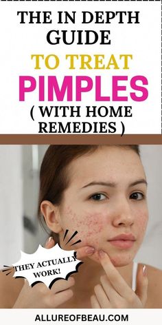 Get Rid Of Pimples Overnight, Rid Of Pimples Overnight, Overnight Remedies, Cystic Acne Remedies, Get Rid Of Pimples, Blind Pimple, Rid Of Pimples, Forehead Acne, Pimples Under The Skin