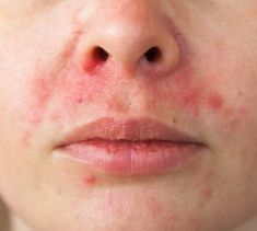 Red Rash, Face Care Routine, Keratosis Pilaris, Forehead Wrinkles, Intj