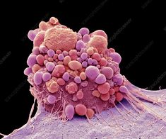 Brain cancer cell apoptosis, SEM - Stock Image - C038/2164 - Science Photo Library Electron Microscope Images, Brain Tumour, Scanning Electron Micrograph, Immune Cells, Personal Investigation, Cells Activity