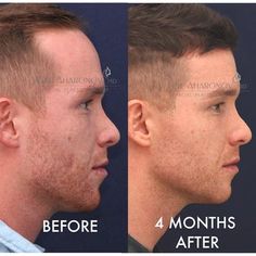 | HAIRLINE LOWERING SURGERY Plastic Surgery, Self Confidence, Self Esteem, 3 Months