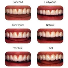 Dental Makeover, Cosmetic Dentistry Veneers, Toothy Smile, Teeth Whitening Homemade, Dental Health Care